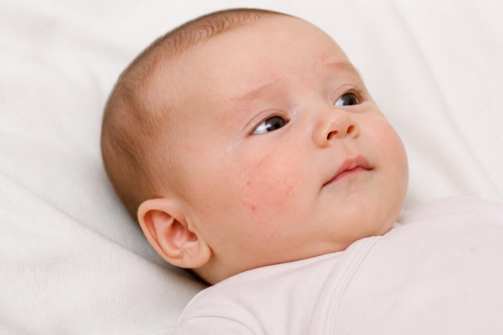 découvrez les causes de l'acné du nourrisson, ses signes et comment prendre soin de la peau sensible de votre bébé pour apaiser ces boutons.